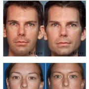 미국인들이 가장 많이하는 얼굴 성형
